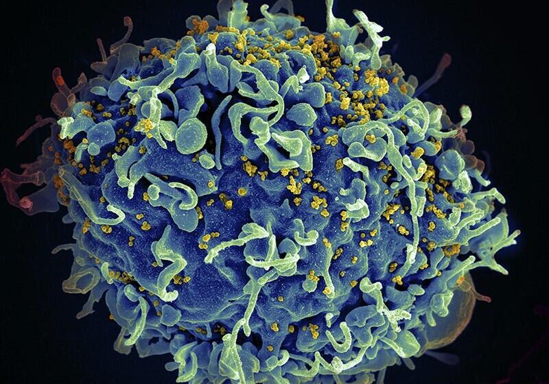  Patient is cured of HIV by own immune system