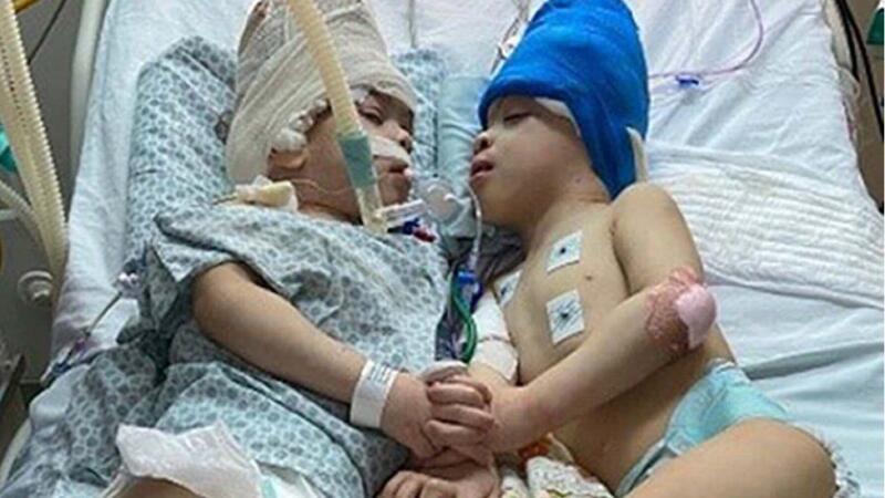 Conjoined Twins Separated With The Help Of VR
