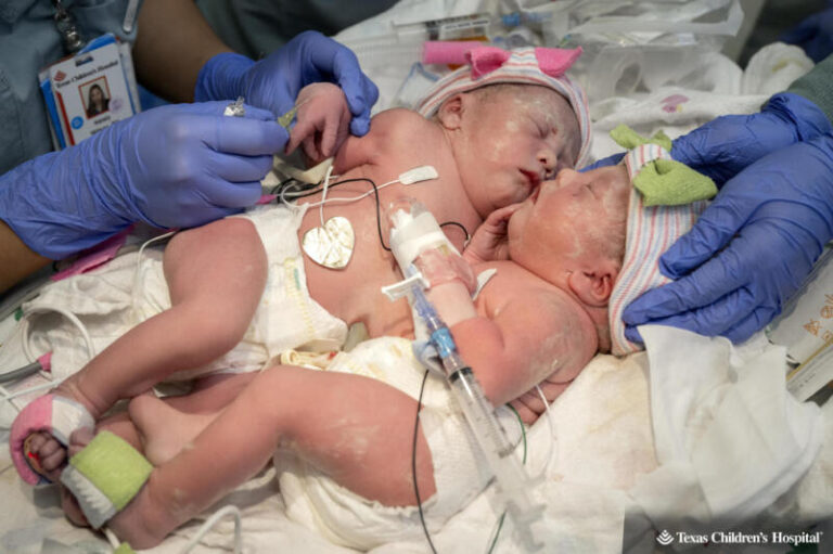 Formerly conjoined twins leave hospital after a four month stay