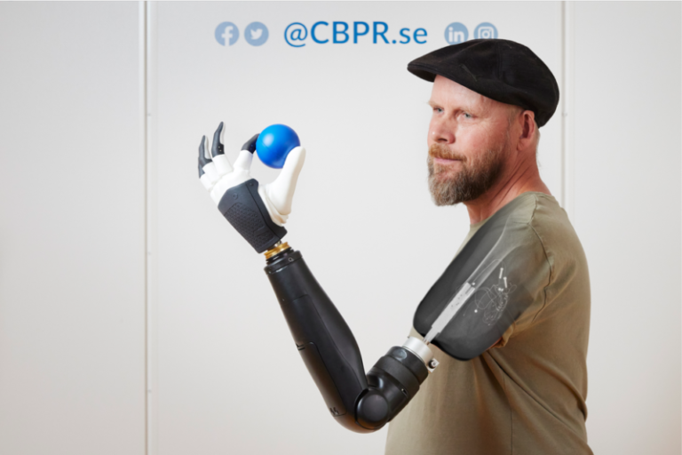New bionic hand allows amputees to accurately control each finger